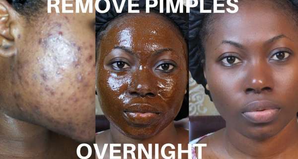 How To Remove Pimples Overnight | Acne Treatment